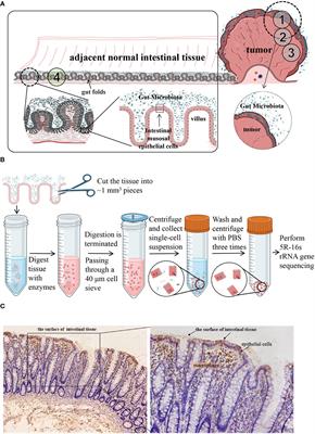 Detection and comparison of tumor cell-associated microbiota from different compartments of colorectal cancer